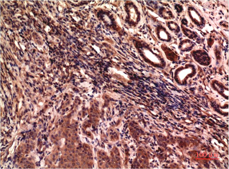 Immunohistochemical analysis of paraffin-embedded Human Breast Carcinoma Tissue using Gamma Tubulin ( EM1302 ) Mouse mAb diluted at 1:200.