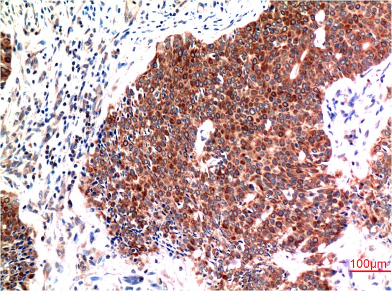 Immunohistochemical analysis of paraffin-embedded Human Breast Carcinoma Tissue using Beclin-1 (EM1304) Mouse mAb diluted at 1:200.