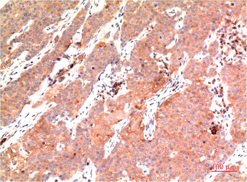 Immunohistochemical analysis of paraffin-embedded Human Breast Carcinoma Tissue using Epsilon Tubulin (EM1311 ) Mouse mAb diluted at 1:200.