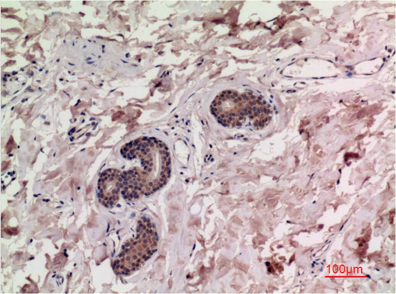 Immunohistochemical analysis of paraffin-embedded Human Breast Carcinoma Tissue using Smad3 (EM1315) Mouse mAb diluted at 1:200.