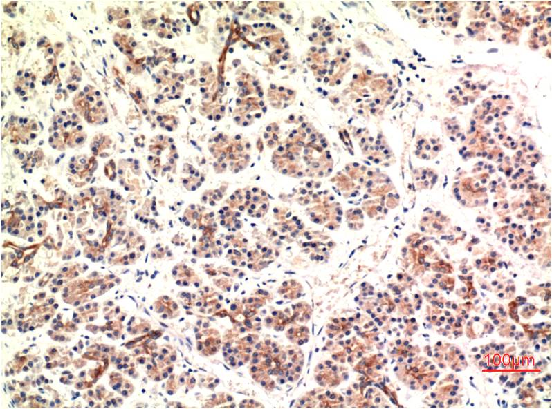 Immunohistochemical analysis of paraffin-embedded Human Pancreas Carcinoma Tissue using CHOP (EM1317) Mouse mAb diluted at 1:200.