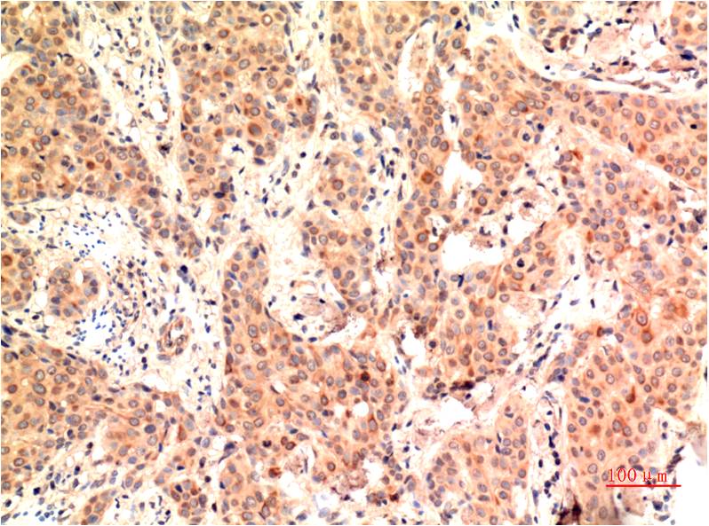 Immunohistochemical analysis of paraffin-embedded Human Breast Carcinoma Tissue using ERK1 (EM1323) Mouse mAb diluted at 1:200.