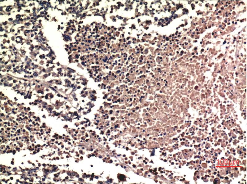 Immunohistochemical analysis of paraffin-embedded Human Lung Carcinoma Tissue using ERK1/2 (EM1326) Mouse mAb diluted at 1:200.