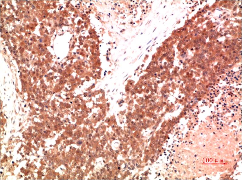 Immunohistochemical analysis of paraffin-embedded Human Lung Carcinoma Tissue using AMPk a1 (EM1327) Mouse mAb diluted at 1:200.