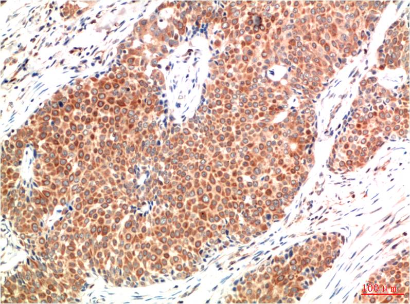 Immunohistochemical analysis of paraffin-embedded Human Breast Carcinoma Tissue using ATM (EM1331) Mouse mAb diluted at 1:200.
