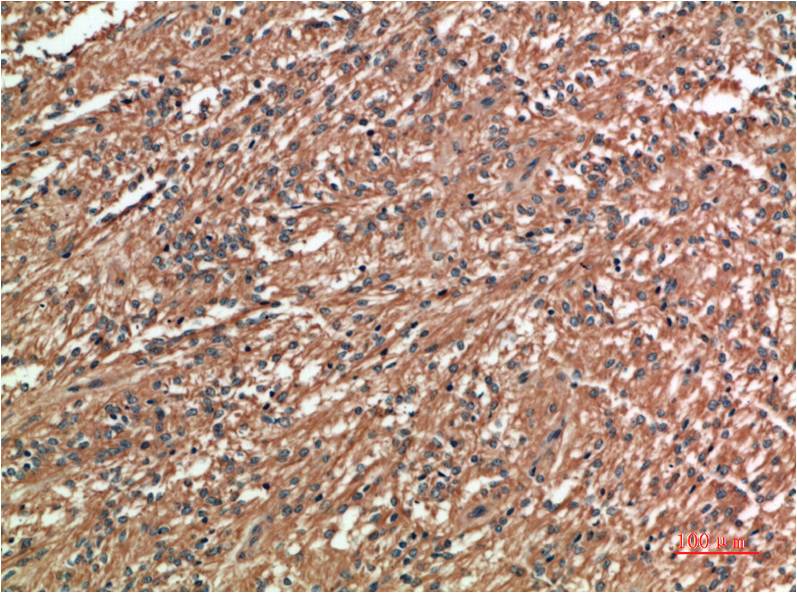Immunohistochemical analysis of paraffin-embedded Human Ovarain Carcinoma Tissue using c-Jun (EM1338) Mouse mAb diluted at 1:200