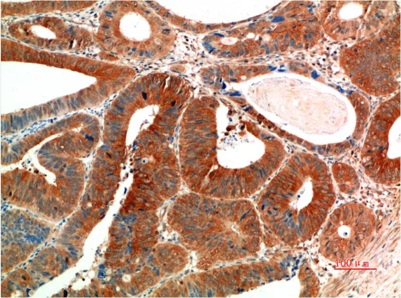 Immunohistochemical analysis of paraffin-embedded Human Colon Carcinoma Tissue using Phospho-ERK1/2 (EM1342) Mouse mAb diluted at 1:200.
