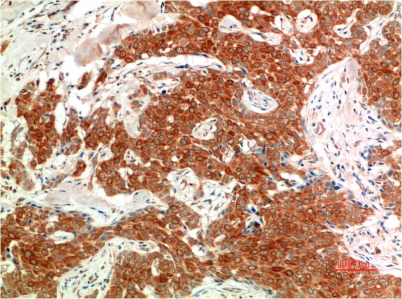 Immunohistochemical analysis of paraffin-embedded Human Breast Carcinoma Tissue using Phospho-ERK1/2 (EM1342) Mouse mAb diluted at 1:200.