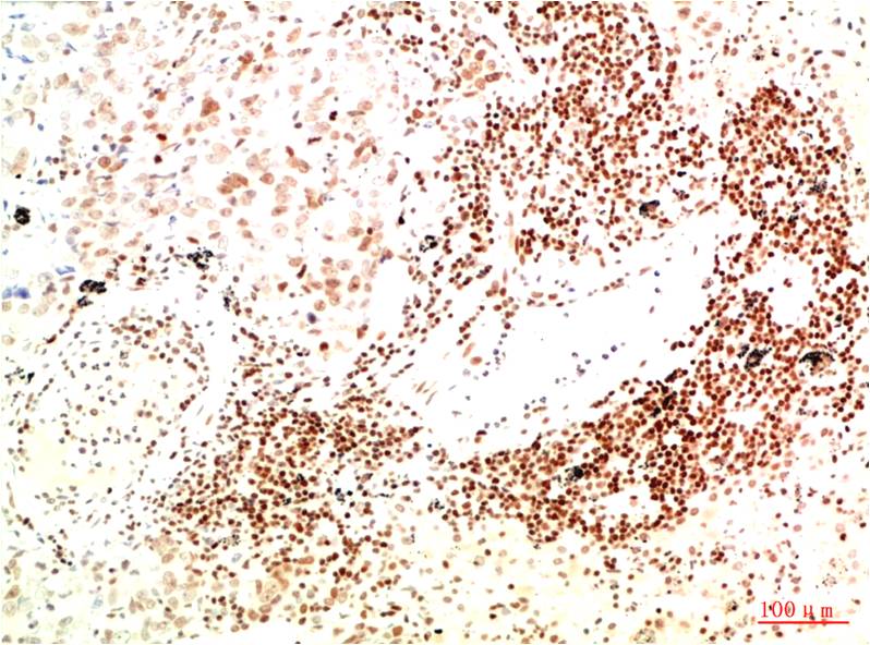 Immunohistochemical analysis of paraffin-embedded Human Lung Carcinoma Tissue using JAK2 (EM1368) Mouse mAb diluted at 1:200.