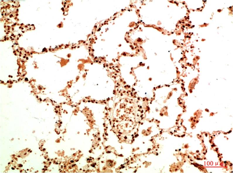 Immunohistochemical analysis of paraffin-embedded Human Lung Carcinoma Tissue using Acetyl NF kB P65(K314/K315) (EM1377) Mouse mAb diluted at 1:200.