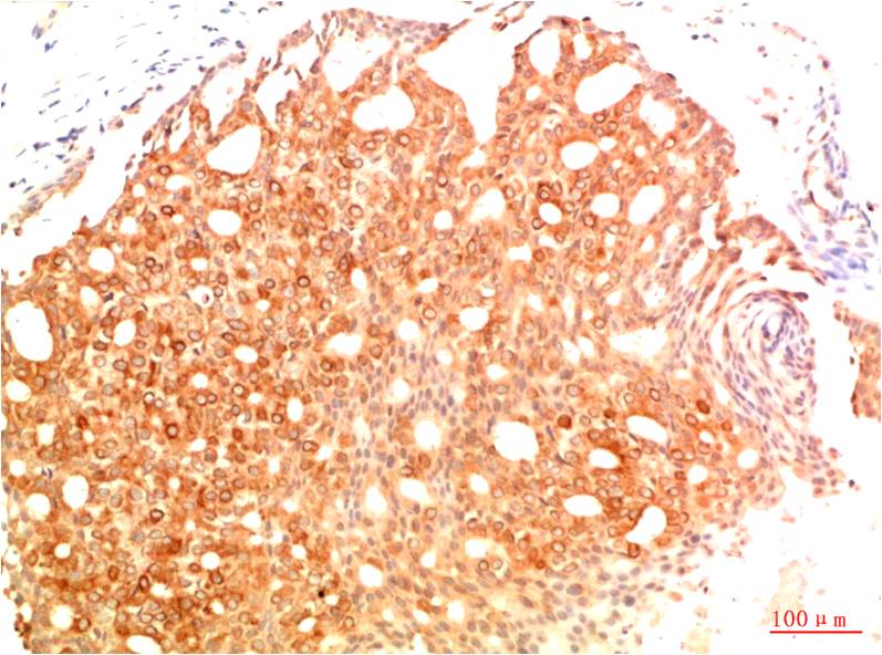 Immunohistochemical analysis of paraffin-embedded Human Breast Carcinoma Tissue using Acetyl P53(K382) (EM1382) Mouse mAb diluted at 1:200.