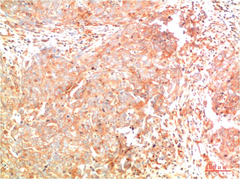 Immunohistochemical analysis of paraffin-embedded Human Breast Carcinoma Tissue using ATG7 (EM1385) Mouse mAb diluted at 1:200.