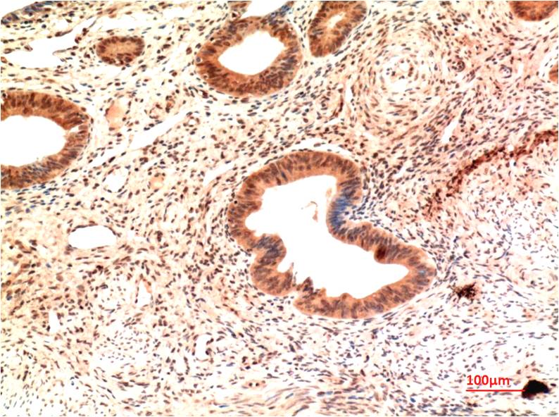 Immunohistochemical analysis of paraffin-embedded Human Endometrial Carcinoma Tissue using Claudin-2 (EM1403) Mouse mAb diluted at 1:200.