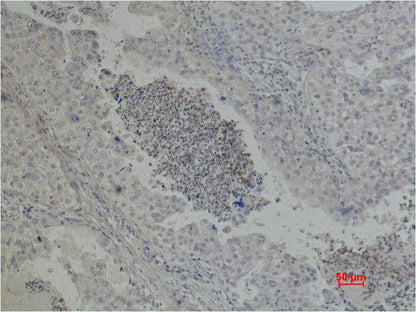 Immunohistochemical analysis of paraffin-embedded Human Lung caricnoma using EGFR  (EM1044) Mouse mAb diluted at 1:500.