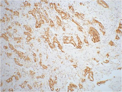 IHC staining of mouse prostate adenocarcinoma tissue with AMACR/P504S mouse mAb(4A12) diluted at 1:200.