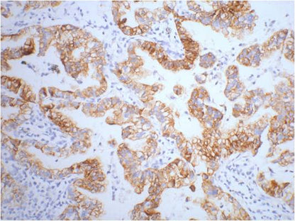 IHC staining of human lung cancer tissue with CK7 mouse mAb(12D7) diluted at 1:200.