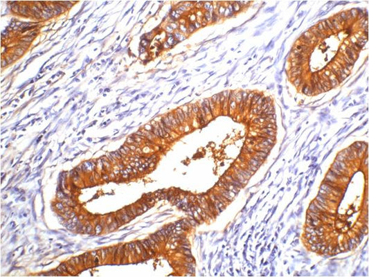 IHC staining of human colon cancer tissue with CEA mouse mAb(10E1) diluted at 1:200.