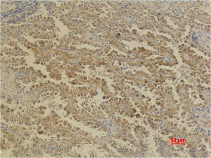Immunohistochemical analysis of paraffin-embedded Human Lung Caricnoma using  CA IX/Carbonic Anhydrase IX (EM1076) Mouse mAb diluted at 1:200.