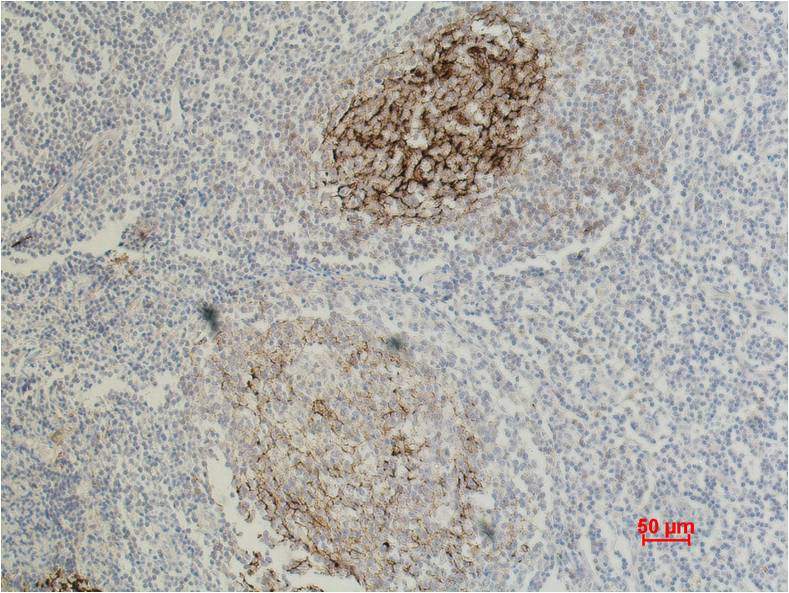 Immunohistochemical analysis of paraffin-embedded Human Tonsil Caricnoma using  CD23 (EM1082) Mouse mAb diluted at 1:500.