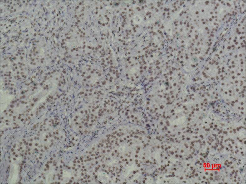 Immunohistochemical analysis of paraffin-embedded Human Breast Caricnoma using  Histone H3(tri methyl K79) (EM1091) Mouse mAb diluted at 1:500.