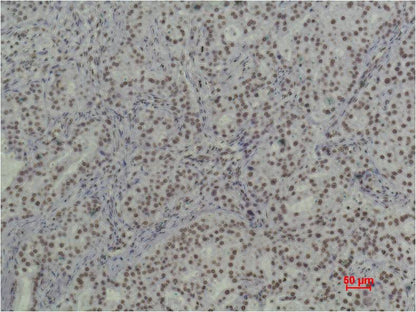 Immunohistochemical analysis of paraffin-embedded Human Breast Caricnoma using  Histone H3(tri methyl K79) (EM1091) Mouse mAb diluted at 1:500.