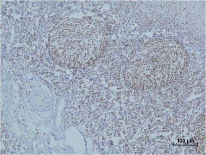 Immunohistochemical analysis of paraffin-embedded human Tonsil Tissue using Cleaved PARP  (EM1132) Mouse mAb diluted at 1:500.
