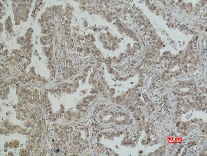 Immunohistochemical analysis of paraffin-embedded Human Lung Caricnoma using  eIF4A1 (EM1136) Mouse mAb diluted at 1:200.
