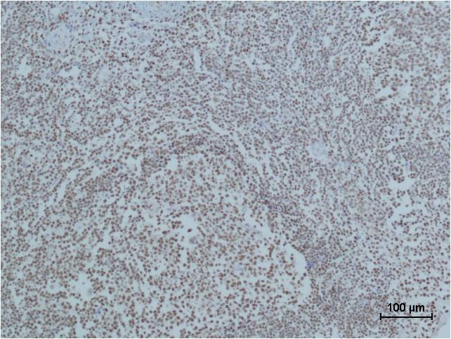 Immunohistochemical analysis of paraffin-embedded human Tonsil Tissue using Cleaved PARP  (EM1145) Mouse mAb diluted at 1:500.
