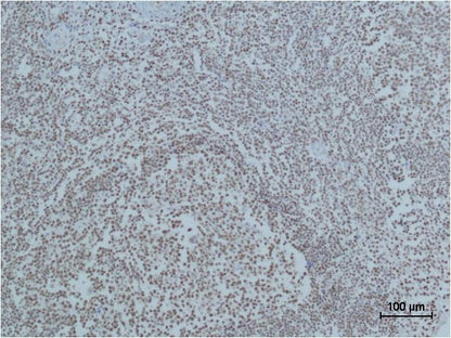 Immunohistochemical analysis of paraffin-embedded human Tonsil Tissue using Cleaved PARP  (EM1145) Mouse mAb diluted at 1:500.