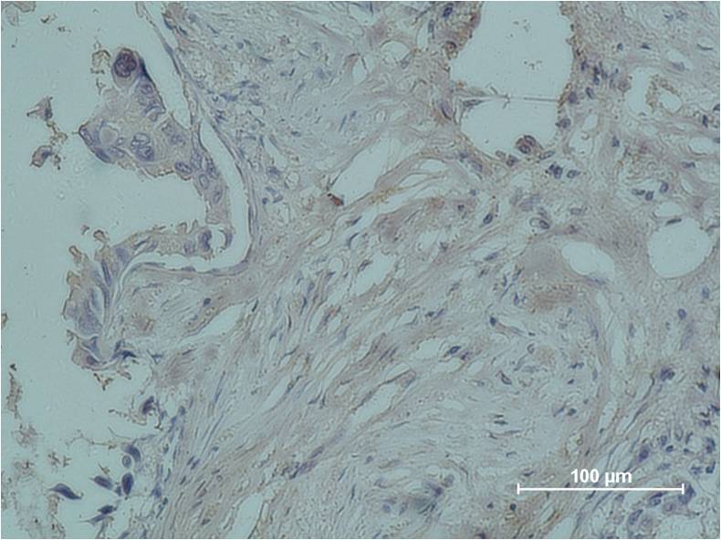 Immunohistochemical analysis of paraffin-embedded human breast caricnoma using Progesterone Receptor  (EM1158) Mouse mAb diluted at 1:500.