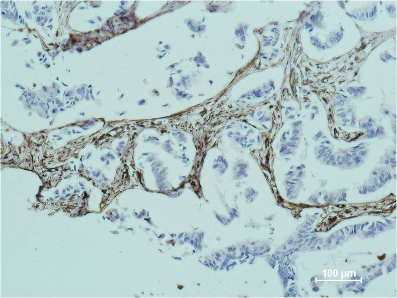 Immunohistochemical analysis of paraffin-embedded human breast caricnoma using Vimentin  (EM1159) Mouse mAb diluted at 1:500.