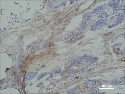 Immunohistochemical analysis of paraffin-embedded human Colon caricnoma using b III tubulin  (EM1166) Mouse mAb diluted at 1:500.