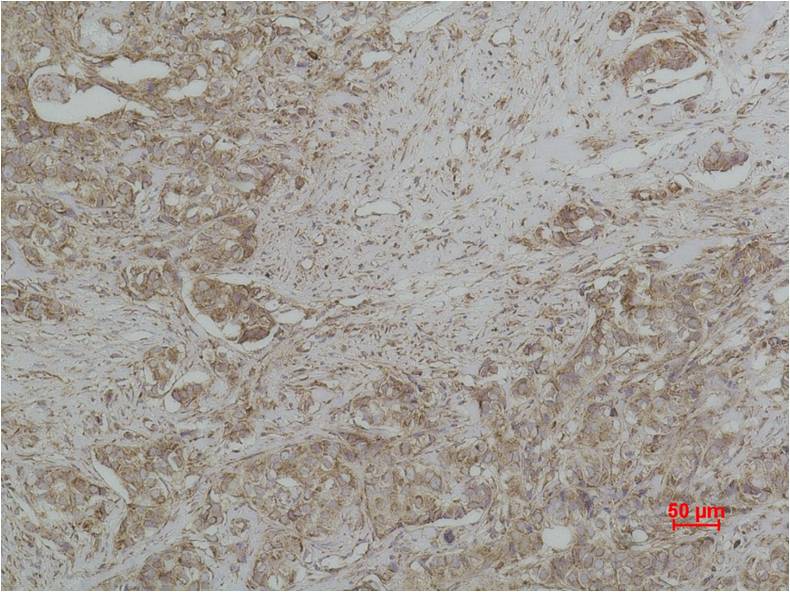 Immunohistochemical analysis of paraffin-embedded human Breast caricnoma using Cytochrome C  (EM1182) Mouse mAb diluted at 1:500.
