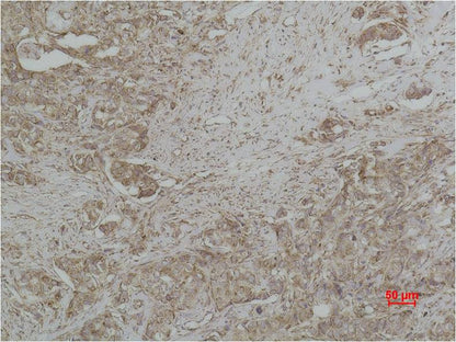 Immunohistochemical analysis of paraffin-embedded human Breast caricnoma using Cytochrome C  (EM1182) Mouse mAb diluted at 1:500.