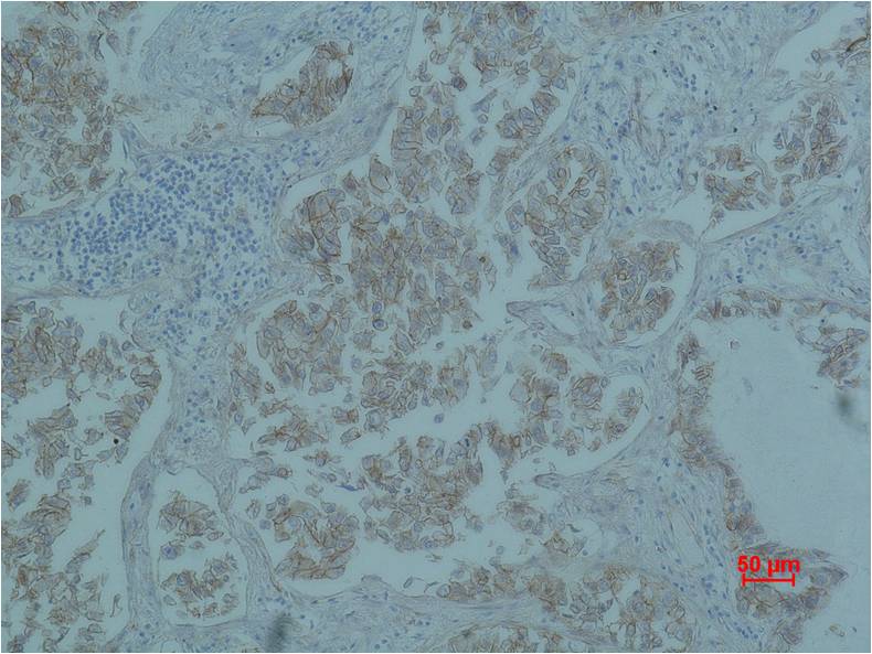 Immunohistochemical analysis of paraffin-embedded Human Lung caricnoma using Beta-Catenin  (EM1183) Mouse mAb diluted at 1:500.