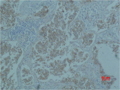 Immunohistochemical analysis of paraffin-embedded Human Lung caricnoma using Beta-Catenin  (EM1183) Mouse mAb diluted at 1:500.