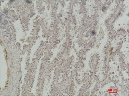 Immunohistochemical analysis of paraffin-embedded Human Lung Carcinoma using  CREB  (EM1185) Mouse mAb diluted at 1:200.