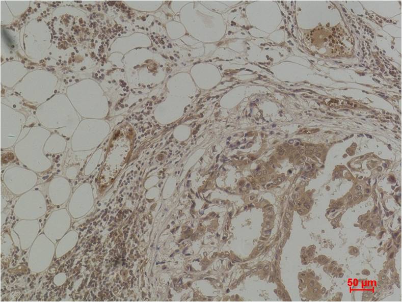 Immunohistochemical analysis of paraffin-embedded Human Breast Carcinoma using  Pan Methylated Lysine (EM1186) Mouse mAb diluted at 1:500.
