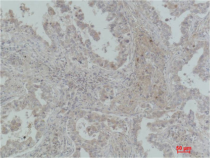 Immunohistochemical analysis of paraffin-embedded Human Lung Carcinoma using  CBARA1/MICU1  (EM1187) Mouse mAb diluted at 1:200.
