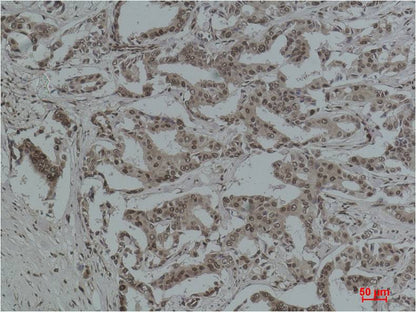 Immunohistochemical analysis of paraffin-embedded Human Breast Carcinoma using  Aceylated Lysine (EM1191) Mouse mAb diluted at 1:500.