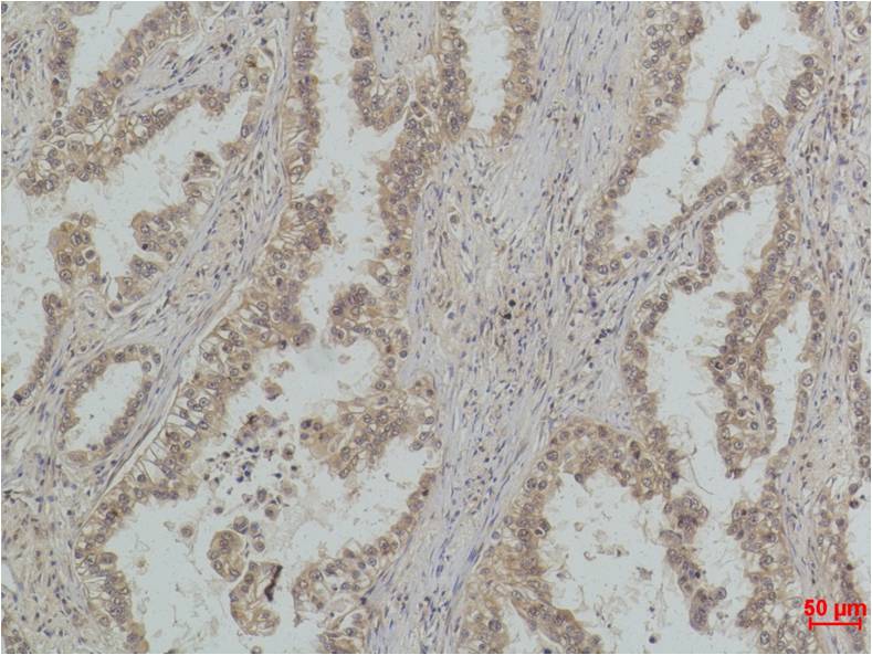 Immunohistochemical analysis of paraffin-embedded Human Lung Carcinoma using  P53(Mono Methyl Lys370) (EM1198) Mouse mAb diluted at 1:500.