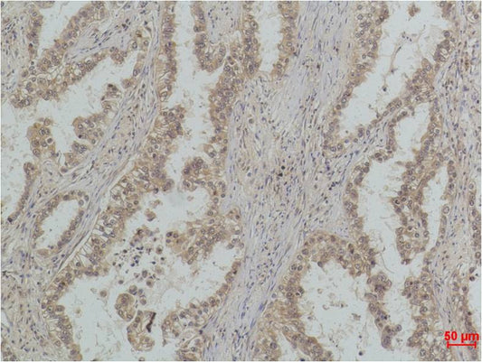 Immunohistochemical analysis of paraffin-embedded Human Lung Carcinoma using  P53(Mono Methyl Lys370) (EM1198) Mouse mAb diluted at 1:500.