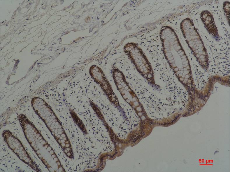 Immunohistochemical analysis of paraffin-embedded Human Colon Caricnoma using  HSP90 Alpha  (EM1199) Mouse mAb diluted at 1:200.