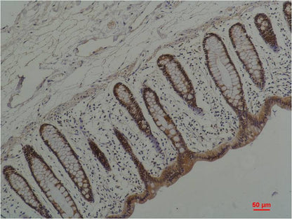 Immunohistochemical analysis of paraffin-embedded Human Colon Caricnoma using  HSP90 Alpha  (EM1199) Mouse mAb diluted at 1:200.
