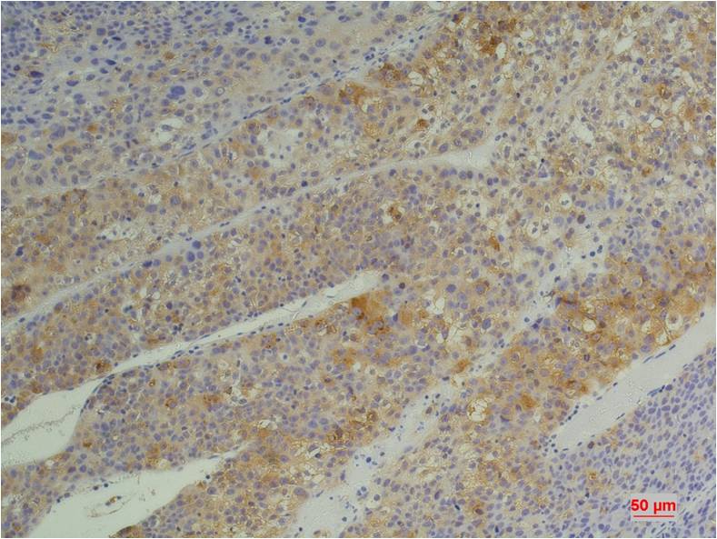 Immunohistochemical analysis of paraffin-embedded Human Heptacarcinoma using Cyclophilin B (EM1219) Mouse mAb diluted at 1:200.