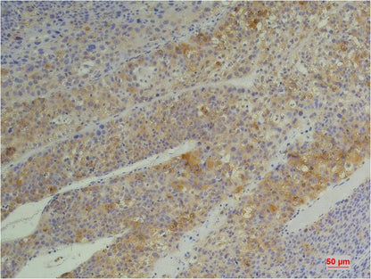 Immunohistochemical analysis of paraffin-embedded Human Heptacarcinoma using Cyclophilin B (EM1219) Mouse mAb diluted at 1:200.