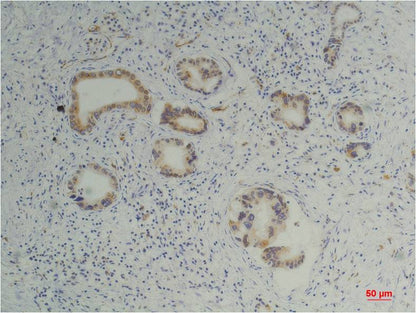 Immunohistochemical analysis of paraffin-embedded Human Pancreatic Carcinoma using Cyclophilin B (EM1219) Mouse mAb diluted at 1:200.