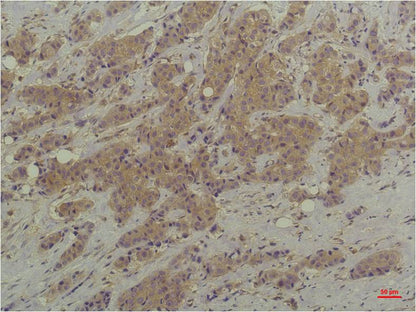 Immunohistochemical analysis of paraffin-embedded Human Breast Carcinoma using P44/42 MAPK (ERK1/2) (EM1221)Mouse mAb diluted at 1:200.