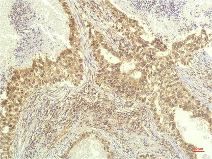 Immunohistochemical analysis of paraffin-embedded Human Lung Carcinoma Tissue using P70 S6 Kinase (EM1253) Mouse mAb diluted at 1:200.