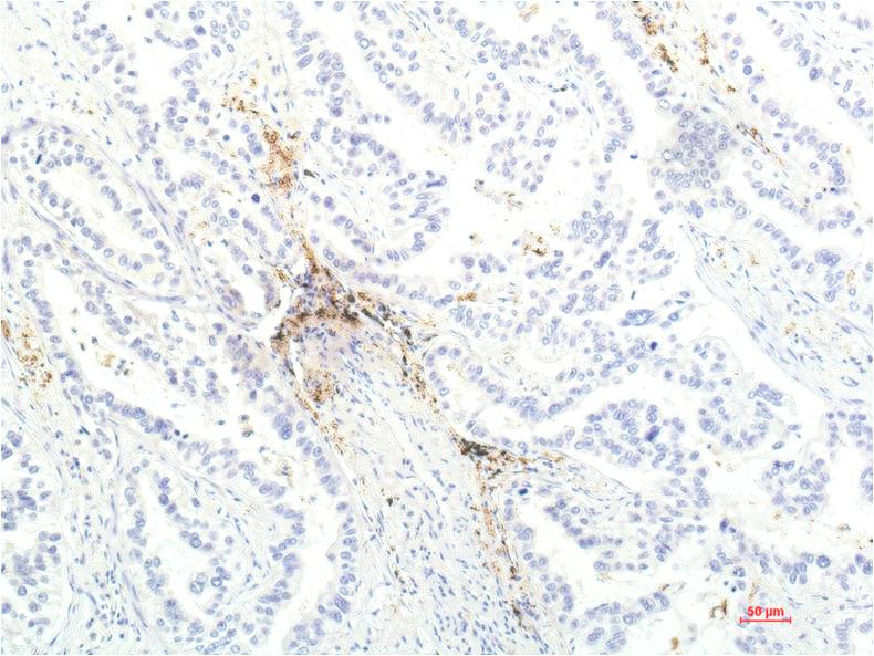 Immunohistochemical analysis of paraffin-embedded Human Lung Carcinoma Tissue using JAK1 (EM1257) Mouse mAb diluted at 1:200.